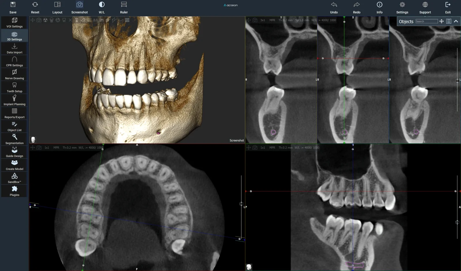 Acteon Imaging Suite met een 3D-weergave en doorsneden van de kaak