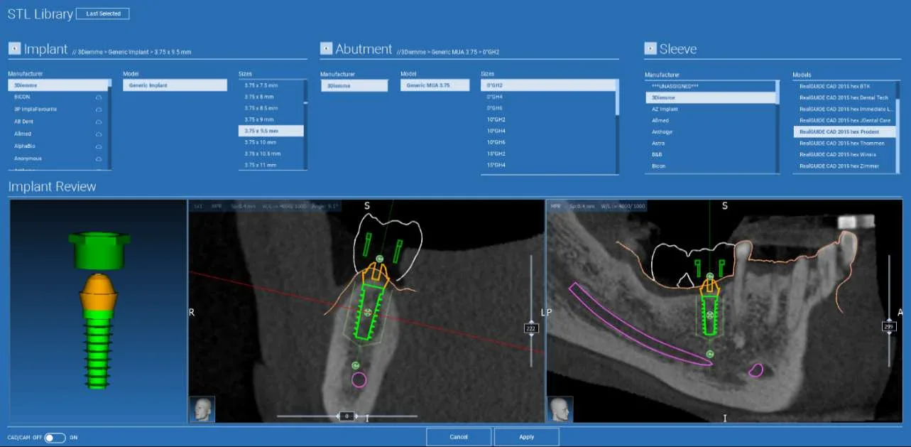 Bibliotheek met implantaat, abutment en huls in RealGUIDE