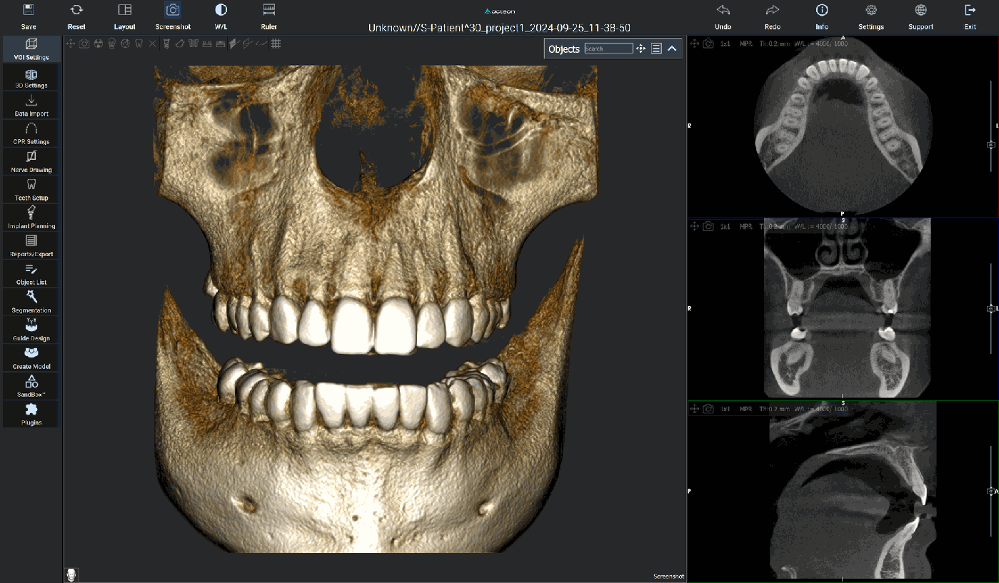 Acteon Imaging Suite en RealGUIDE met een 3D-opname