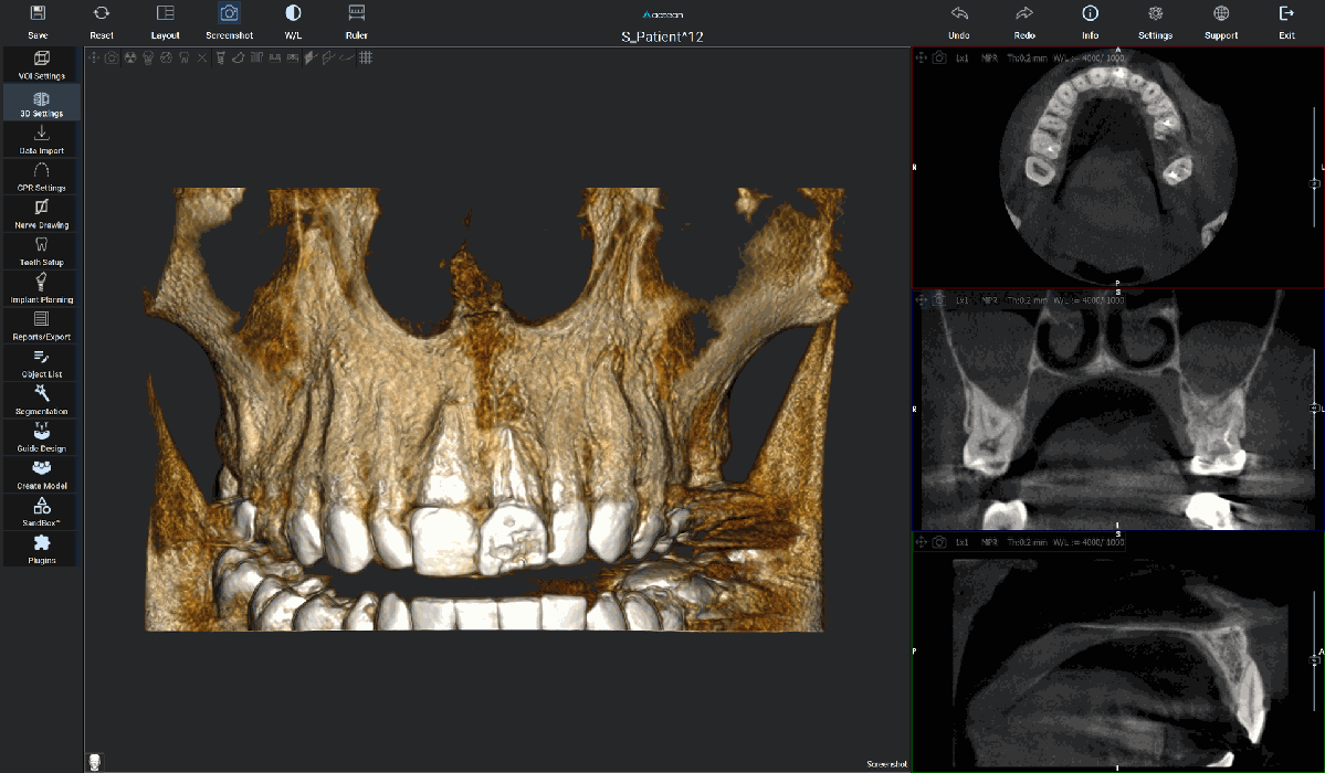 Acteon RealGUIDE met een 3D-opname van de bovenkaak en doorsneden voor implantaatplanning