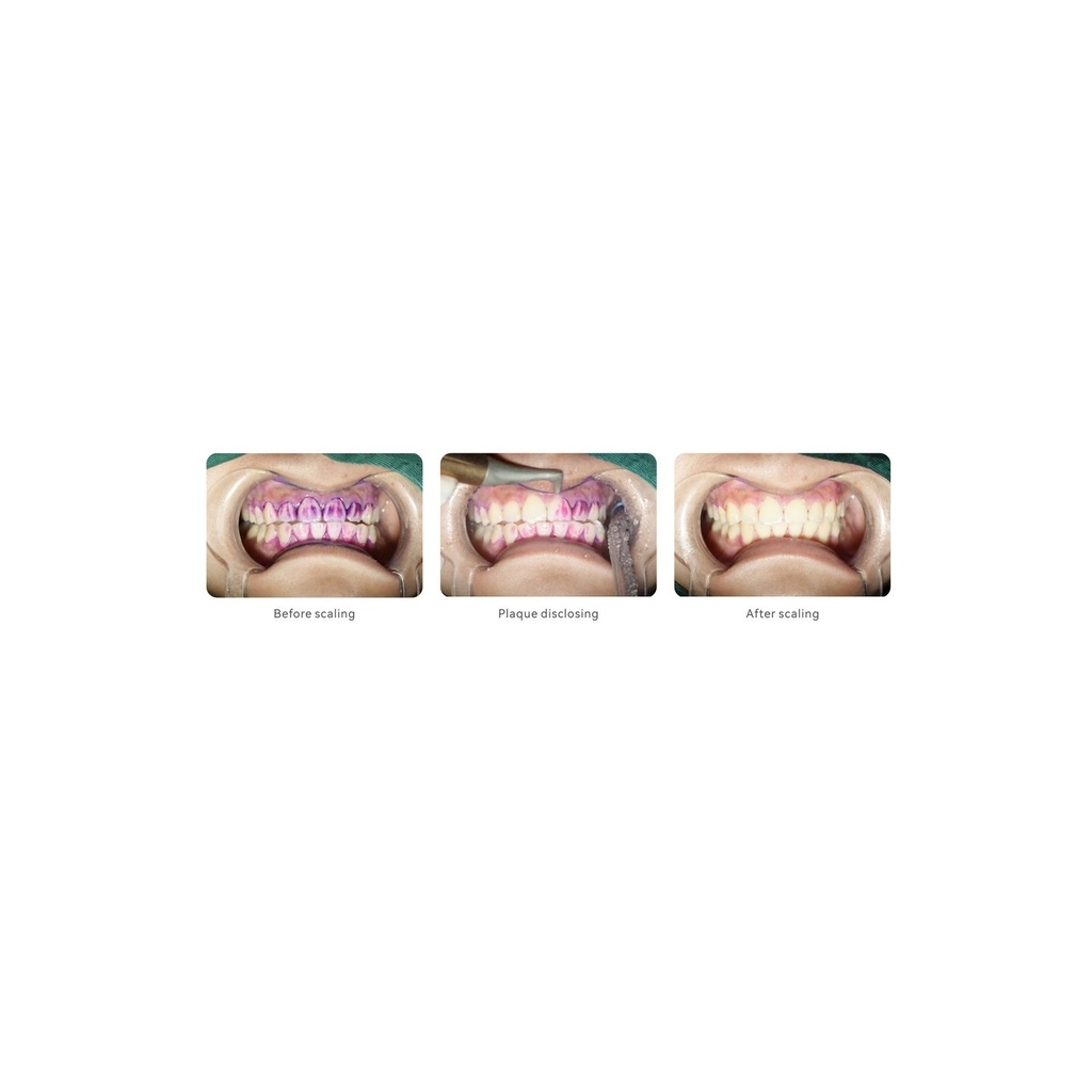 Woodpecker AP-B ultrasoon scaler en airpolisher, wit (5)