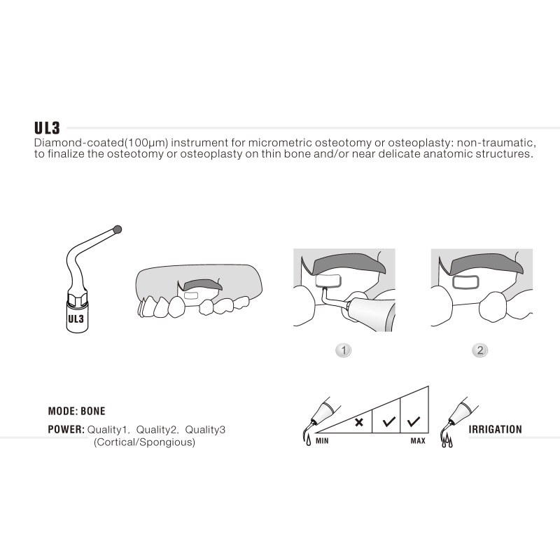 Woodpecker UL3 ultrachirurgische tip voor sinuslift (3)