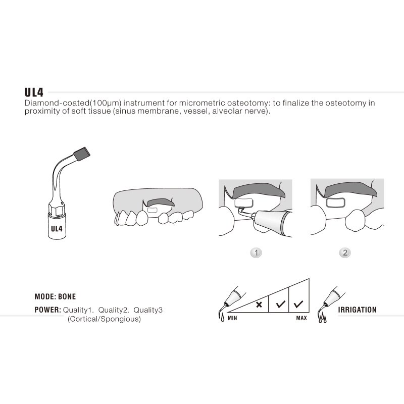 Woodpecker UL4 ultrachirurgische tip voor sinuslift (3)