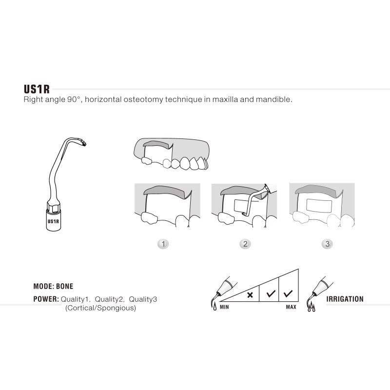 Woodpecker US1R ultrachirurgische tip voor botchirurgie (3)