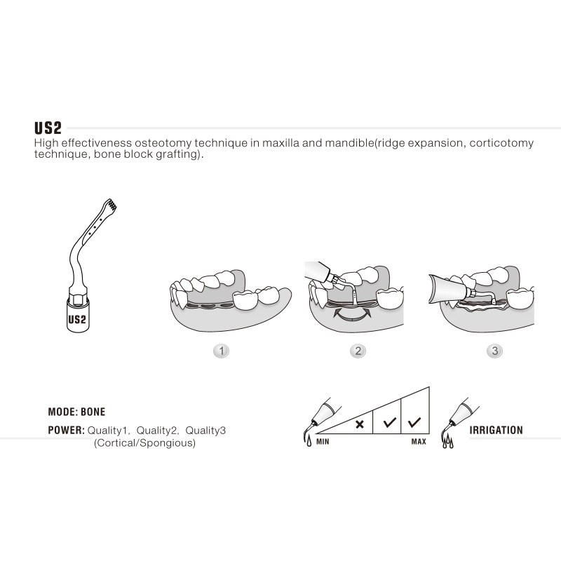 Woodpecker US2 ultrachirurgische tip voor botchirurgie (3)