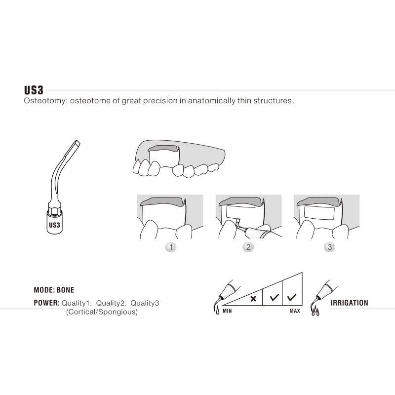 Woodpecker US3 ultrachirurgische tip voor botchirurgie (3)