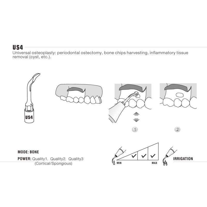 Woodpecker US4 ultrachirurgische tip voor botchirurgie (3)