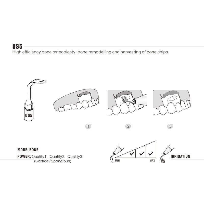 Woodpecker US5 ultrachirurgische tip voor botchirurgie (3)