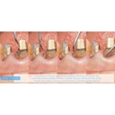 KERN, Tunneling Kit (4)