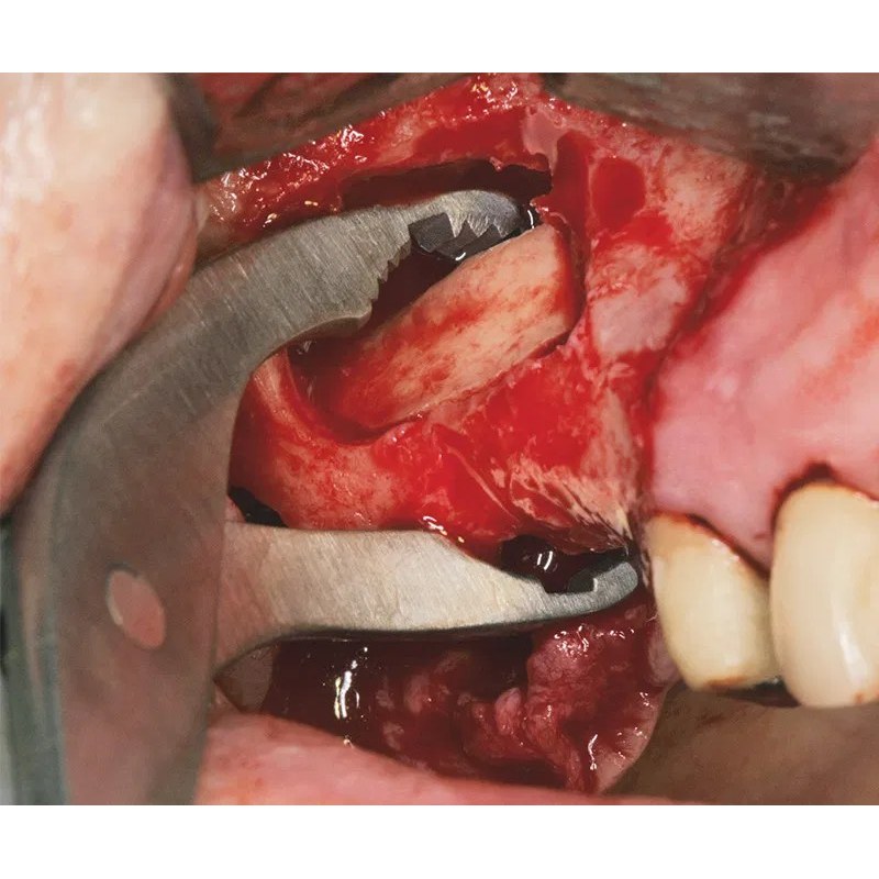 NENTWIG, bone holding and fix.fcps., str (2)
