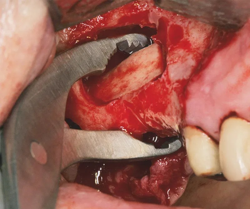 NENTWIG, bone holding and fix.fcps., str (2)