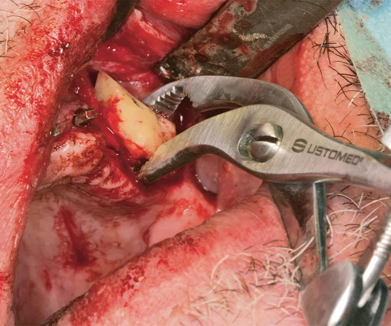 NENTWIG, bone holding and fix.fcps., str (3)