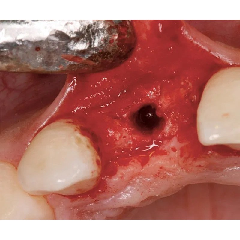 NENTWIG, Bone Spread.Instr., 8 pc., scal (3)