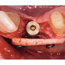 Bone-Fixation-Set, Ø 1, 0/1, 2mm (4)
