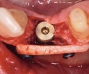 Bone-Fixation-Set, Ø 1, 0/1, 2mm (4)
