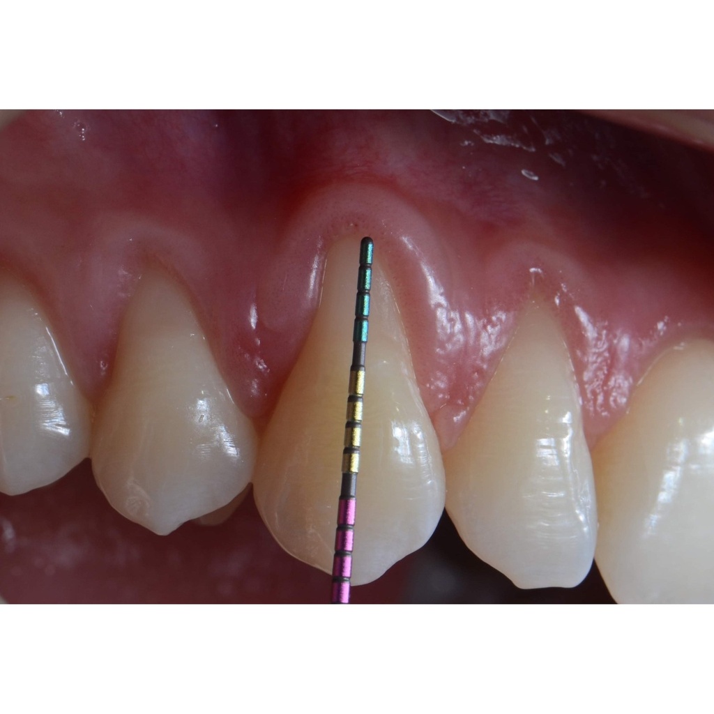 Ustomed ASLAN parodontale sonde 23 mm, kleurcodering, PEEK (2)