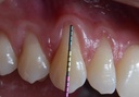 Ustomed ASLAN parodontale sonde 23 mm, kleurcodering, PEEK (2)